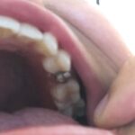 布達佩斯看牙後牙醫裝的假牙根
